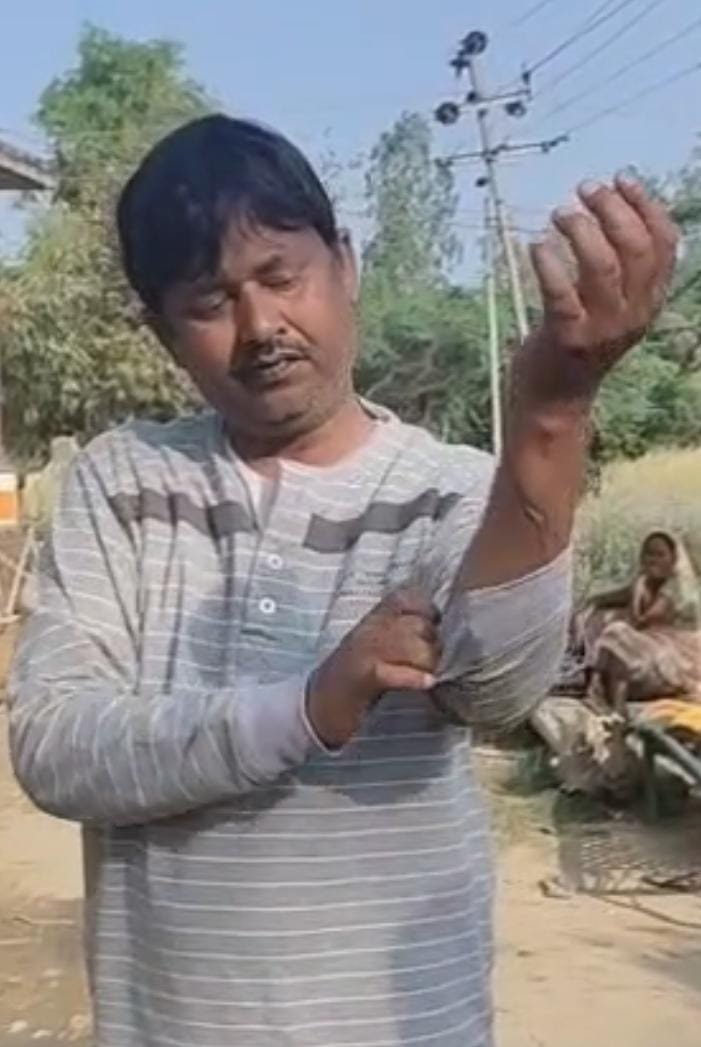 ऊंचाहार:बिजली के तार की चपेट में आने से ग्रामीण गंभीर रूप से झुलसा, विभाग पर लापरवाही का आरोप