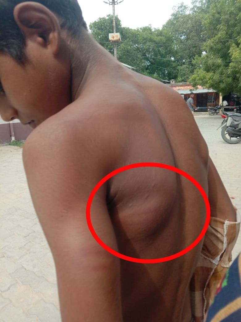 Raibareli-शिक्षक के ऊपर बंद कमरे में बच्चे पर सरिया से मारने का लगा आरोप।