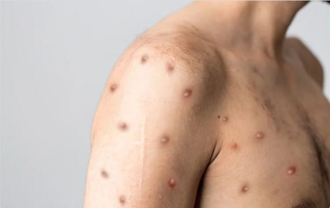 मंकीपॉक्स जांच के लिए देश की पहली स्वदेशी टेस्ट किट लॉन्च, अब जल्द लगया जा सकेगा संक्रमण का पता